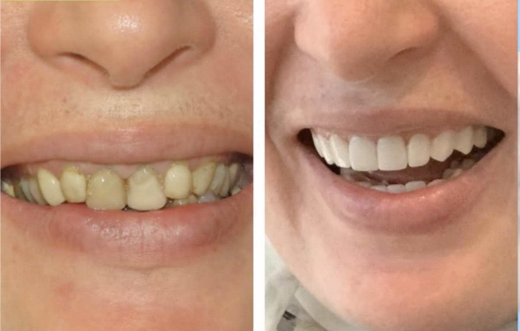 Video describing the use of aligners in orthodontics treatments and its advantages